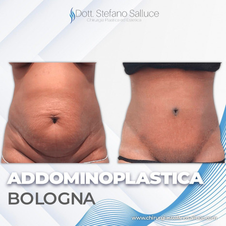 Addominoplastica Bologna Dott. Stefano Salluce